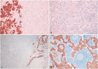 Challenges of FGFR2 Testing in Gastric Cancer